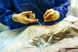 Abdominal surgery 